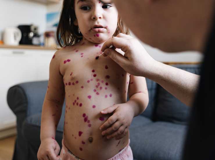 Allerta morbillo OMS - Inchiostroverde.it (Fonte foto Canva)