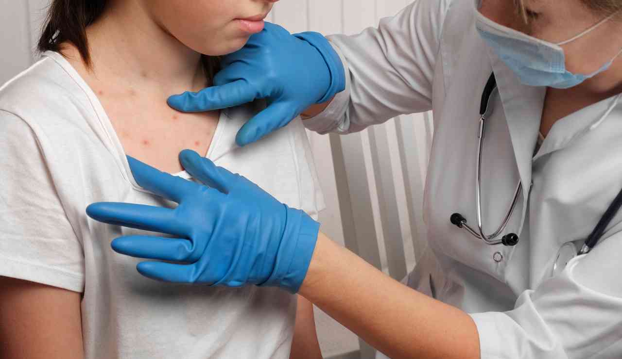 Allerta morbillo OMS - Inchiostroverde.it (Fonte foto Canva)