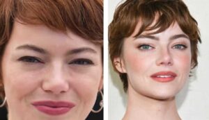 Emma Stone chirurgia