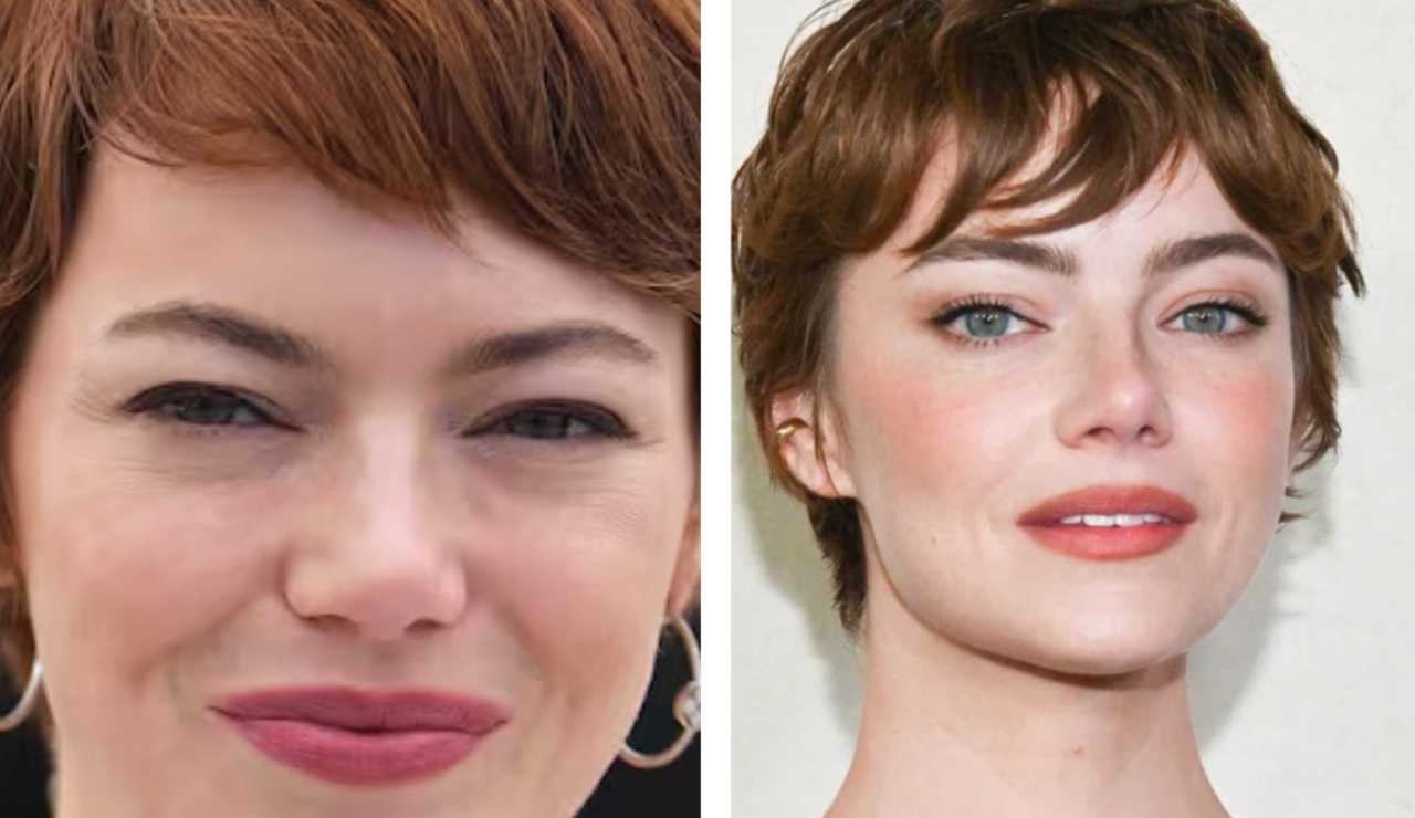 Emma Stone chirurgia